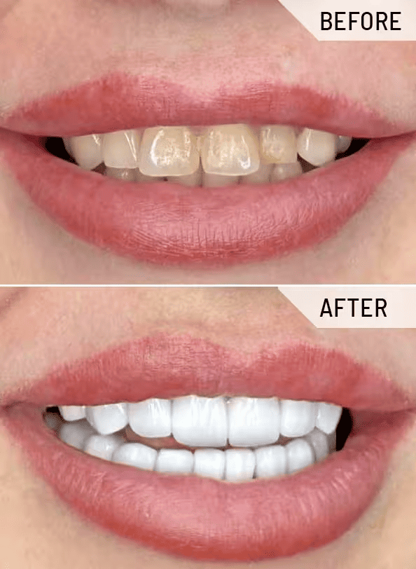 Dentolyn-before-after